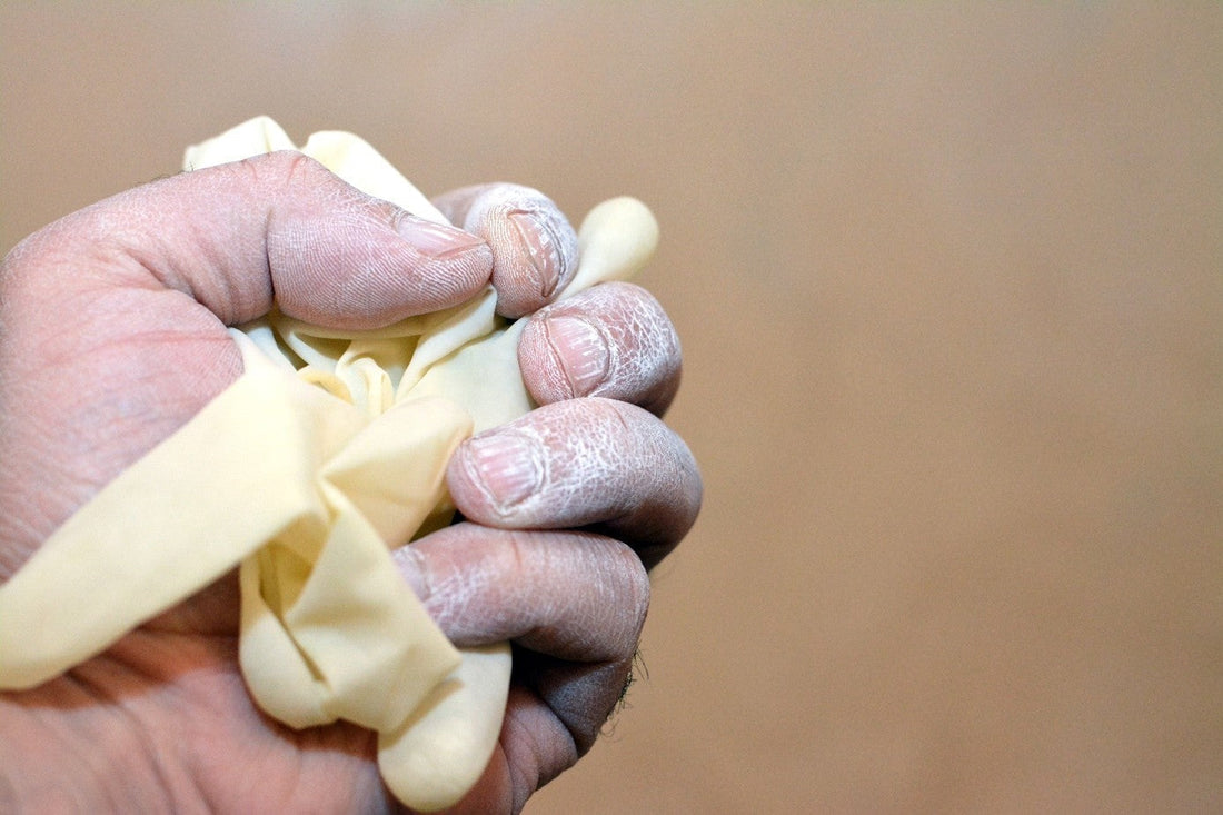 Allergie gegen Handschuhe verhindern und richtig behandeln