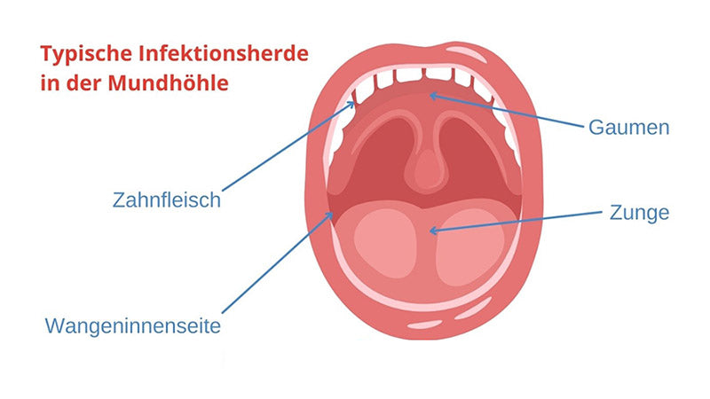 wunddesinfektion-mundhoehle