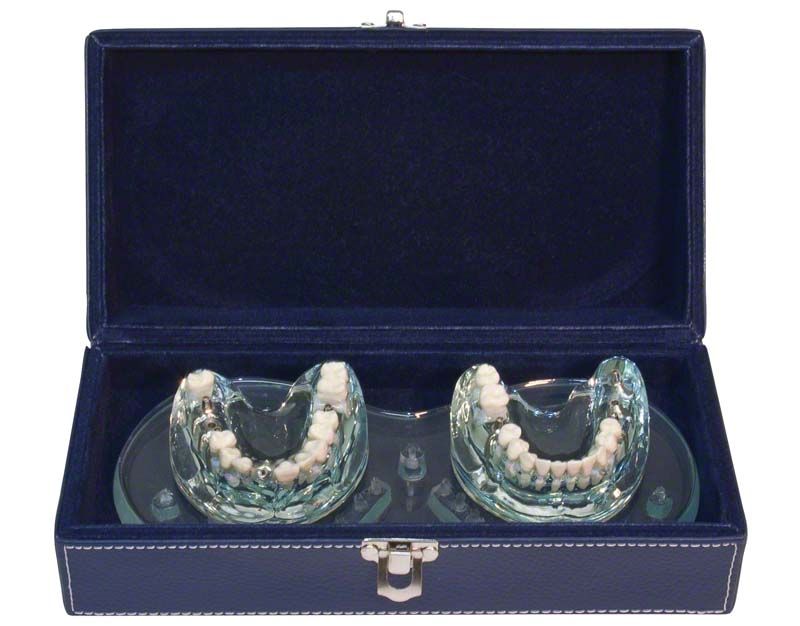 Studienmodell Demo Implant C+B in einem offenen Etui.