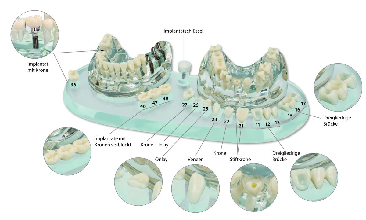 Studienmodell Demo Implant C+B mit nummerierten Zahnimplantaten und Kronen auf Ständer.