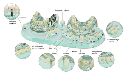 Studienmodell Demo Implant C+B mit nummerierten Zahnimplantaten und Kronen auf Ständer.