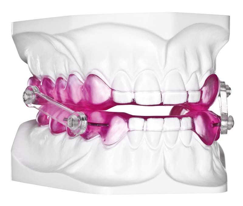 Neonpinkes Autopolymerisat Durasplint® auf Zahnmodell für kieferorthopädische Anwendungen.