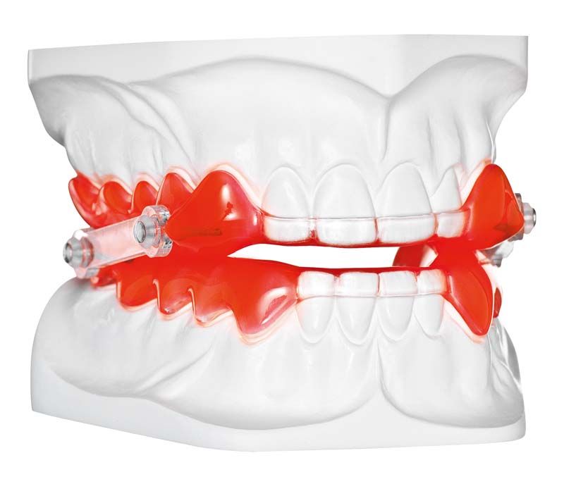 Detailansicht eines Zahnschienenmodells mit neonroten STEADY-RESIN Verbindungen.