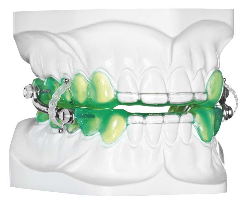 Neongrüne kieferorthopädische Schiene aus STEADY-RESIN auf Zahnmodell.