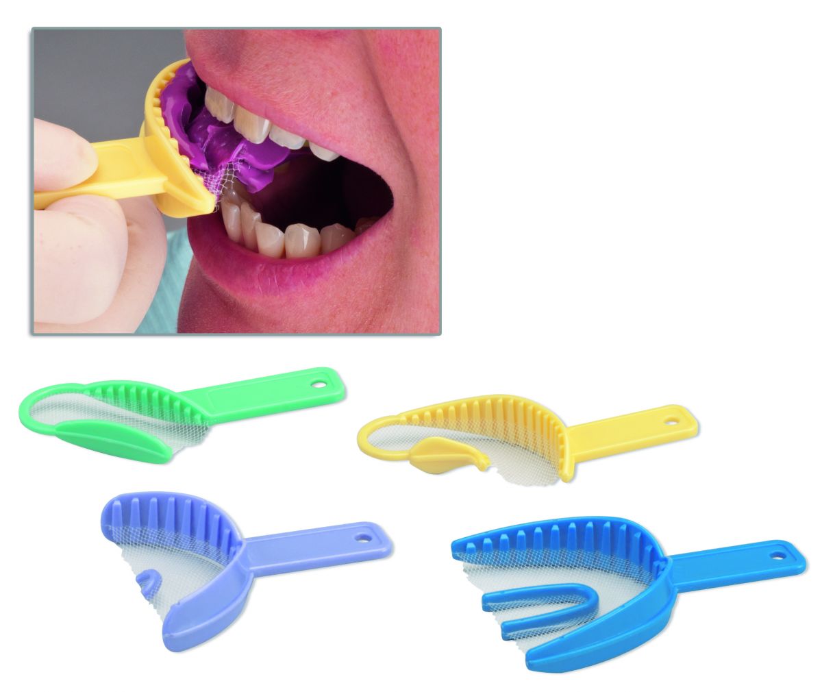 Miratray® 3 in 1 Anterior lila Abformlöffel bei zahnärztlicher Anwendung im Mund.