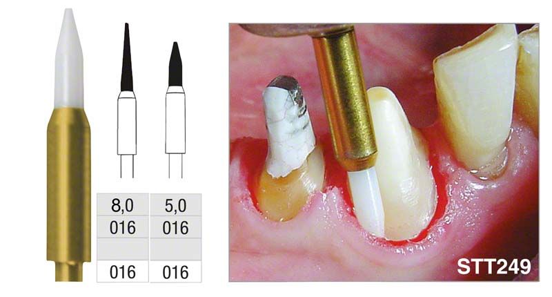 Keramischer Gewebetrimmer STT249 bei Zahnfleischbehandlung im Einsatz.