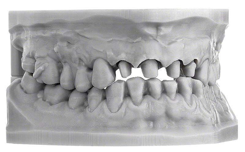 Graues 3D-gedrucktes Dentalmodell mit detaillierter Zahnstruktur.
