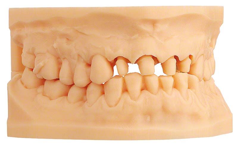 Nahaufnahme eines hochpräzisen Dentalmodells aus beigem IMPRIMO® LC Model Harz.
