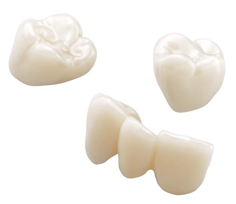 Drei Zahnkronen- und Brückenelemente aus IMPRIMO® LC Temp A1 Material.