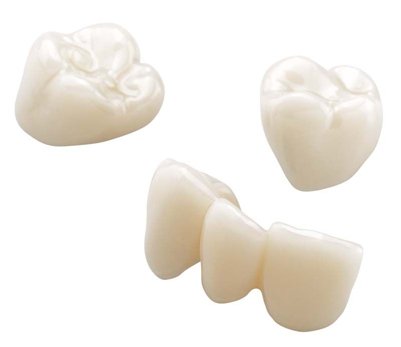 Drei Zahnkronen in Zahnfarbe, Nahaufnahme von IMPRIMO® LC Temp A2.