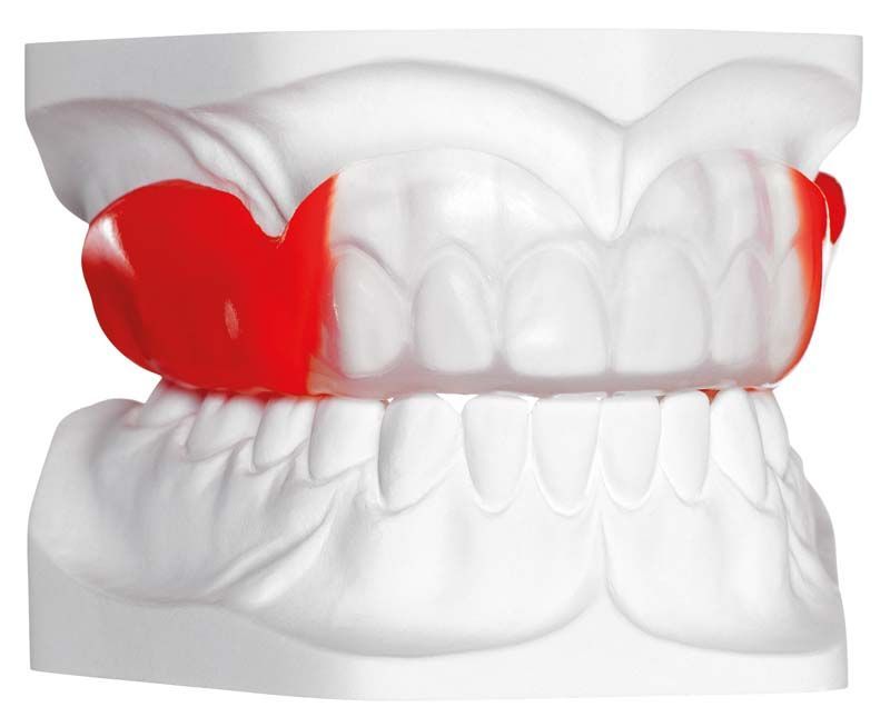 Roter Sportmundschutz mit verstärktem Frontzahnbereich auf weißem Zahnmodell.