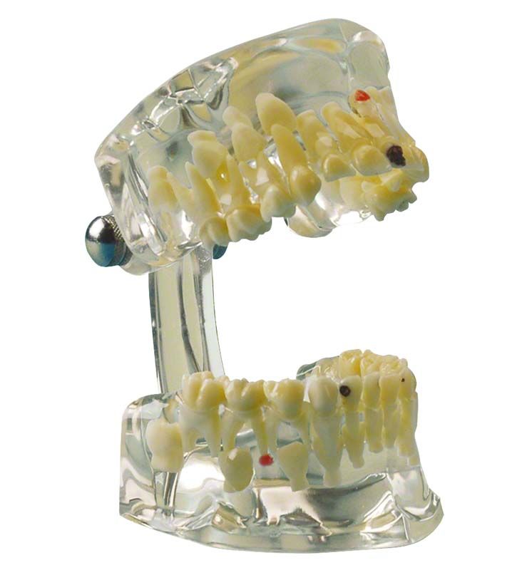 Transparenter kieferorthopädischer Studienmodell mit künstlichen Zähnen und Metallgelenk.