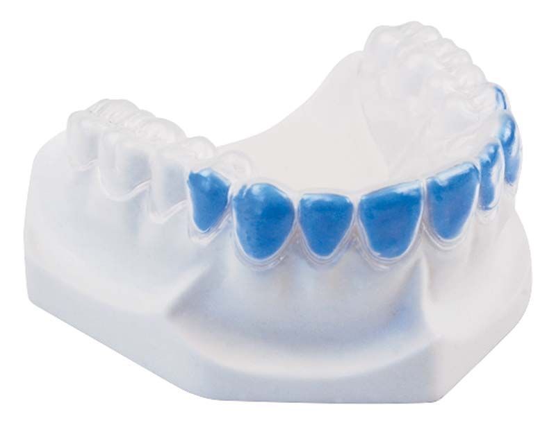 Weichelastische Tiefziehfolie auf Zahnschiene angewendet, für individuelle Bleichschienen.