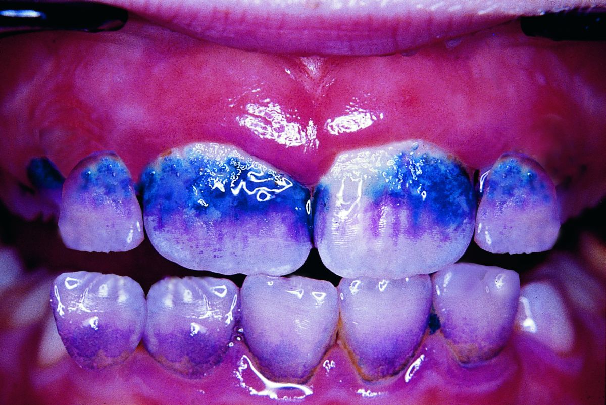 Zähne mit Mira-2-Ton® Lösung gefärbt, ältere Plaque blau, neue rosa.