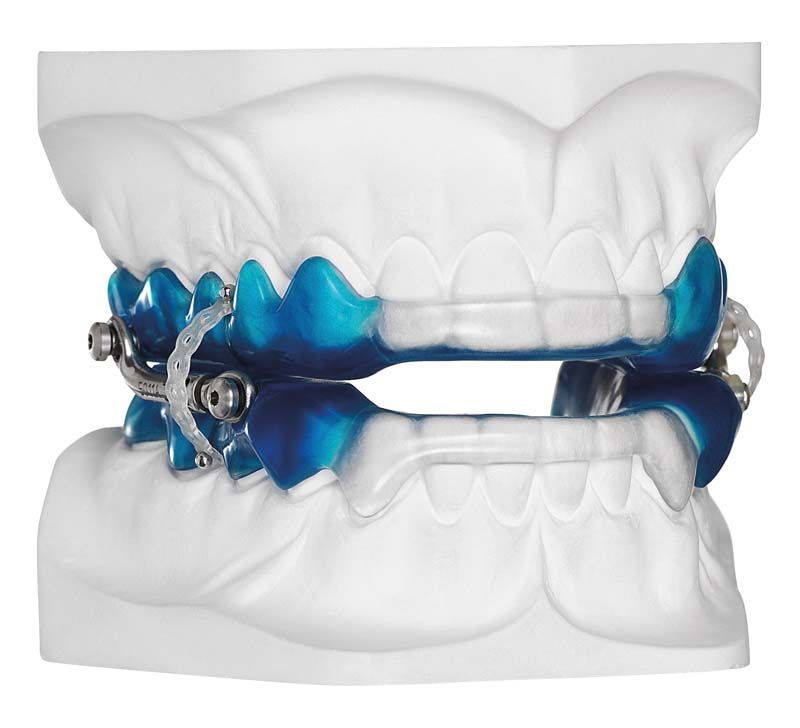 Detailansicht eines blauen Autopolymerisat-Geräts auf einem Zahnmodell.