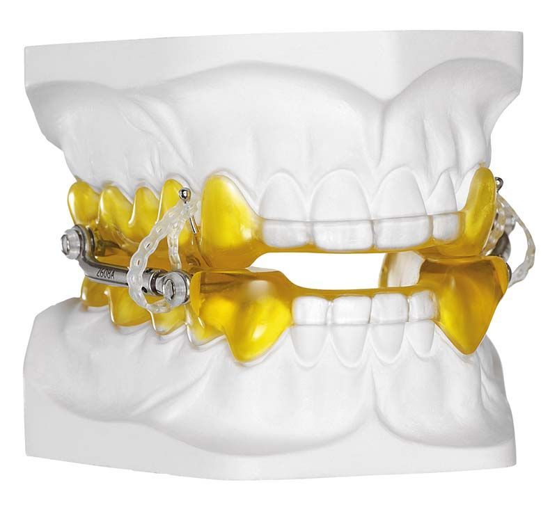 Kiefermodell mit gelbem Steady-Resin Farbmonomer in Zahnspangenanwendung.