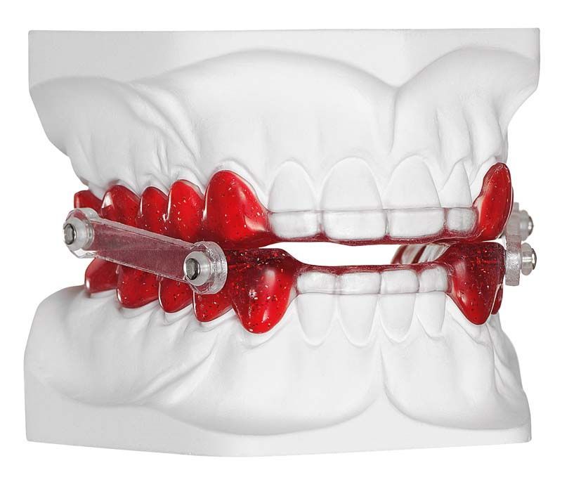 Detailansicht eines dentalen Modells mit rotem Autopolymerisat für Kieferorthopädie.