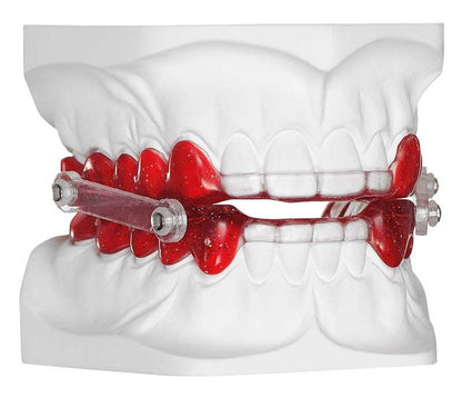 Detailansicht eines dentalen Modells mit rotem Autopolymerisat für Kieferorthopädie.