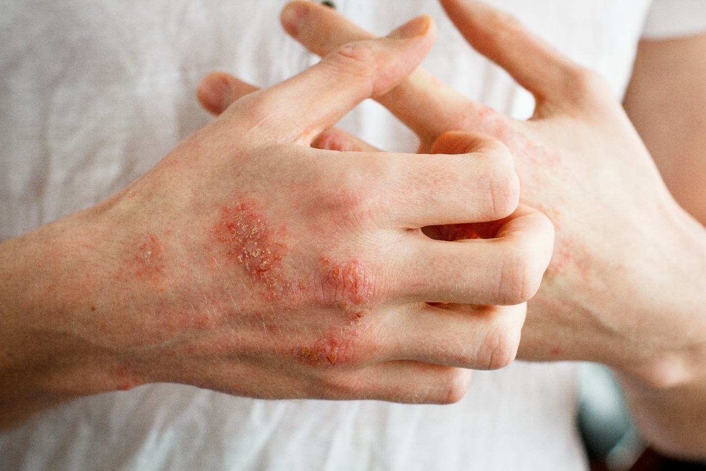 Unangenehme Reaktionen von Allergikern bei einer Handschuhallergie